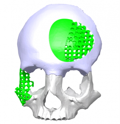 Medical implant with a spherical lattice structure. 