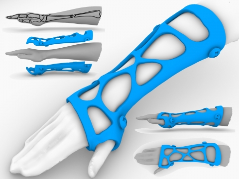 Voronoi Splint, 3D printed cast
